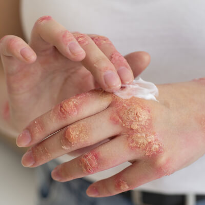 Skin Disorder image